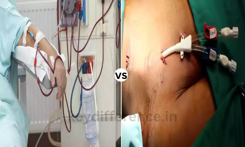 Difference Between Dialysis and Hemodialysis