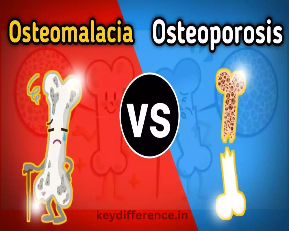 Difference Between Osteoporosis and Osteomalacia