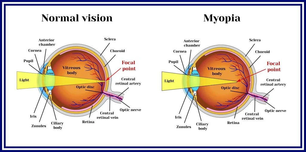 Similarities Between Hypermetropia and Myopia