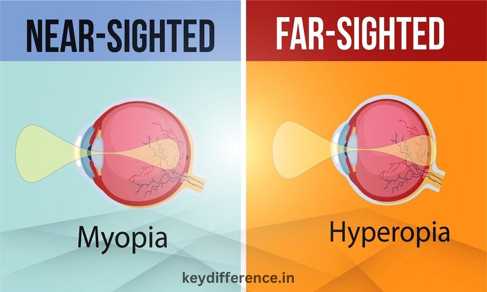 Hypermetropia and Myopia