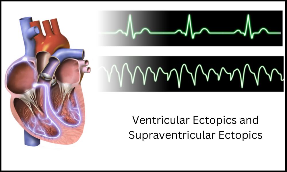 Ventricular Ectopics and Supraventricular Ectopics