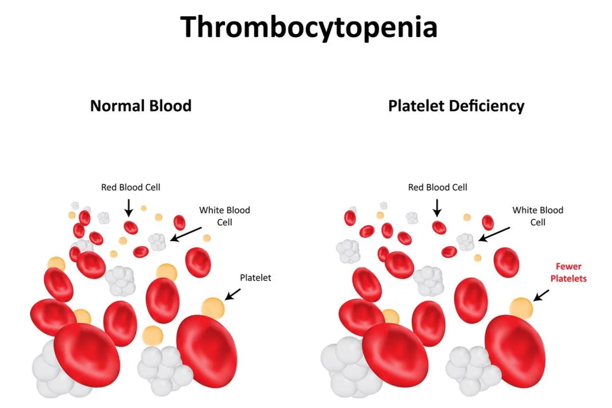 Definition of thrombocytopenia