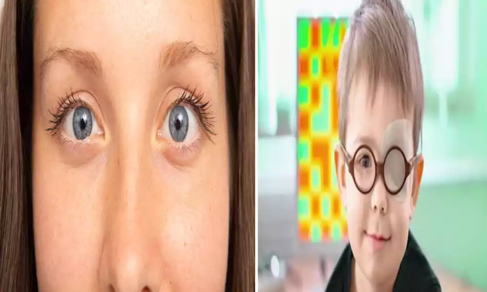 Difference Between Amblyopia and Strabismus