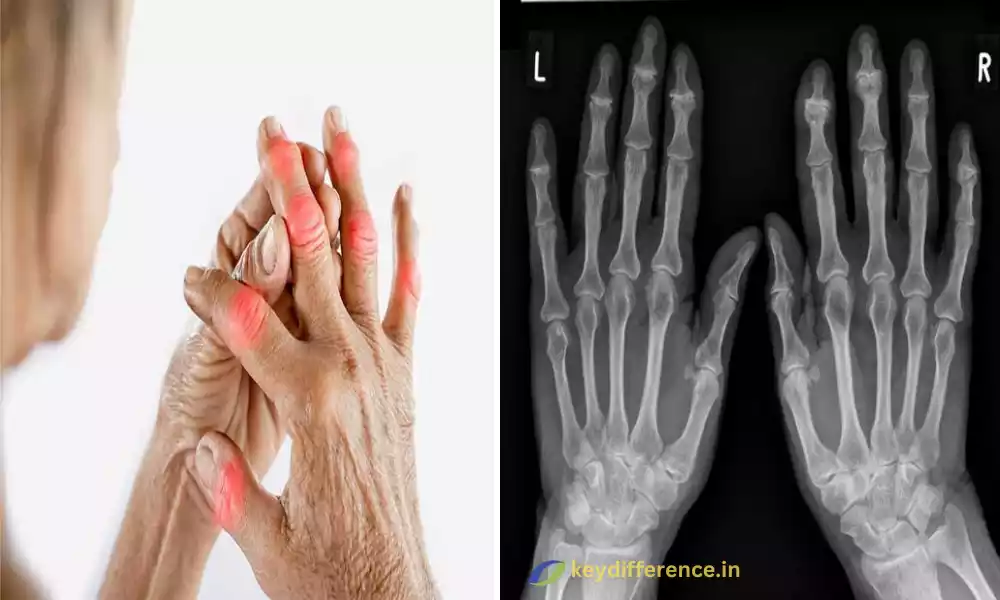 What is the 7 Difference Between Arthritis and Arthropathy