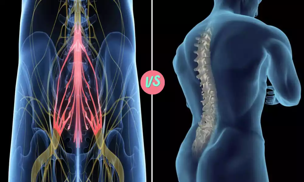 Difference Between Cauda Equina and Conus Medullaris Syndrome