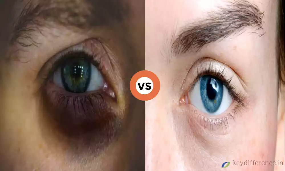 What is 9 the Difference Between Eye Bags and Dark Circles