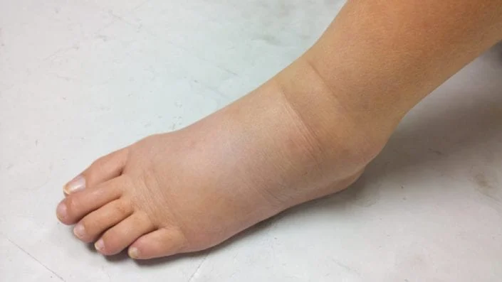 Lymphedema Insufficiency
