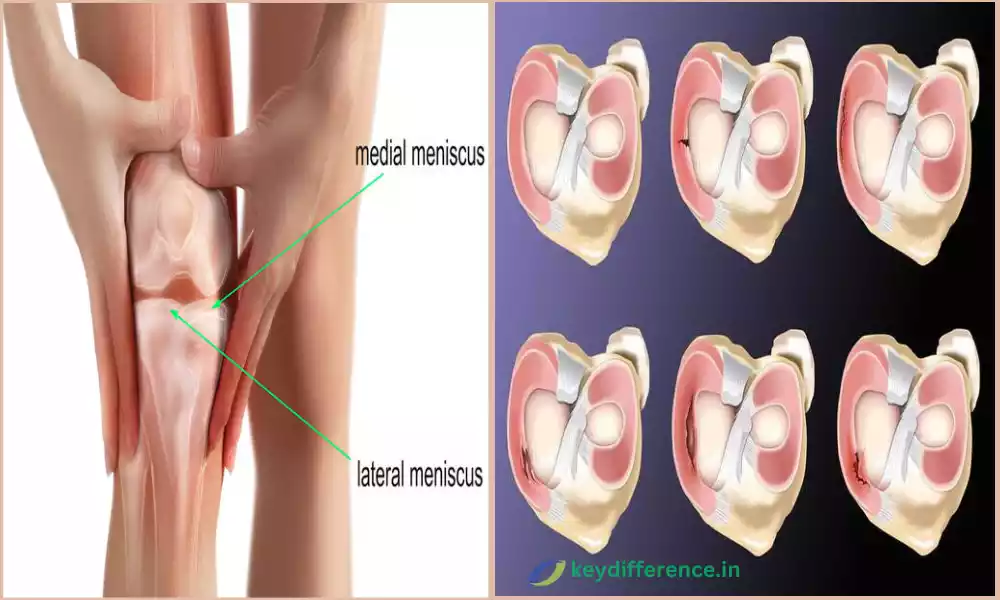 Medial and Lateral Meniscus Tear