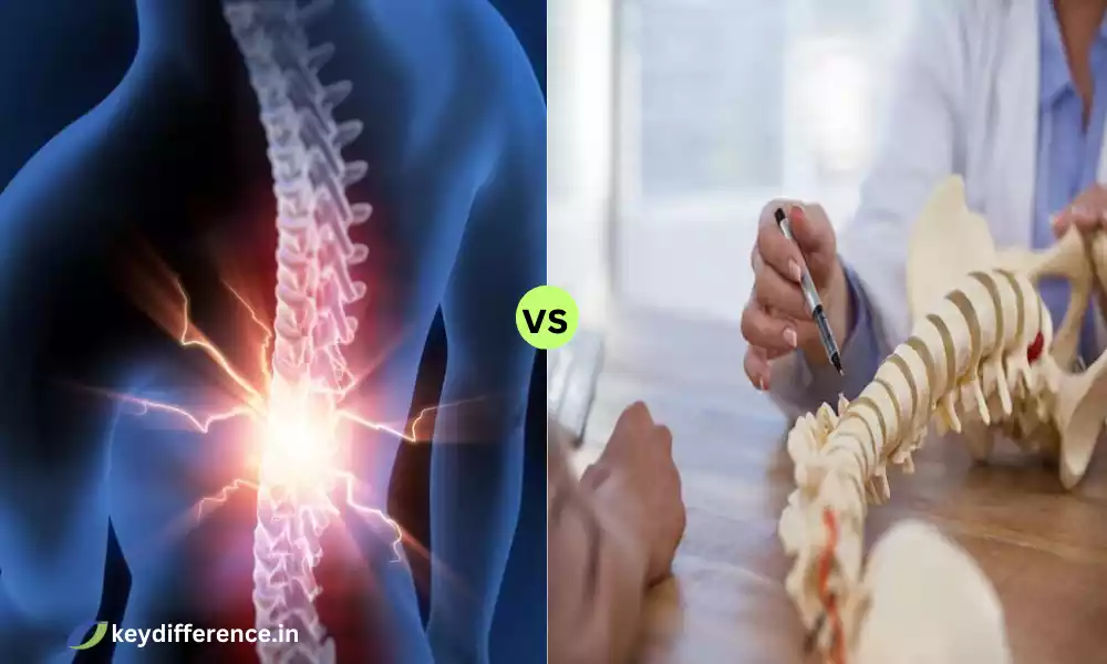 Difference Between Anterolisthesis and Spondylolisthesis