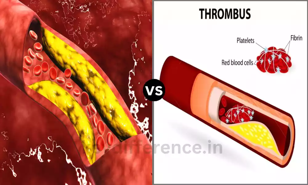 Atheroma and Thrombus