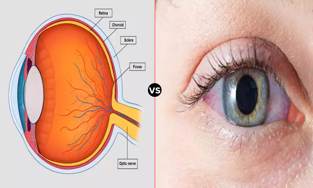 Top 10 Difference Between Choroid and Sclera