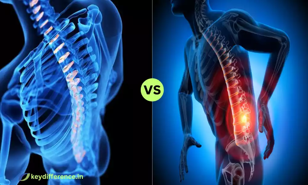 Difference Between Herniated and Bulging Disc