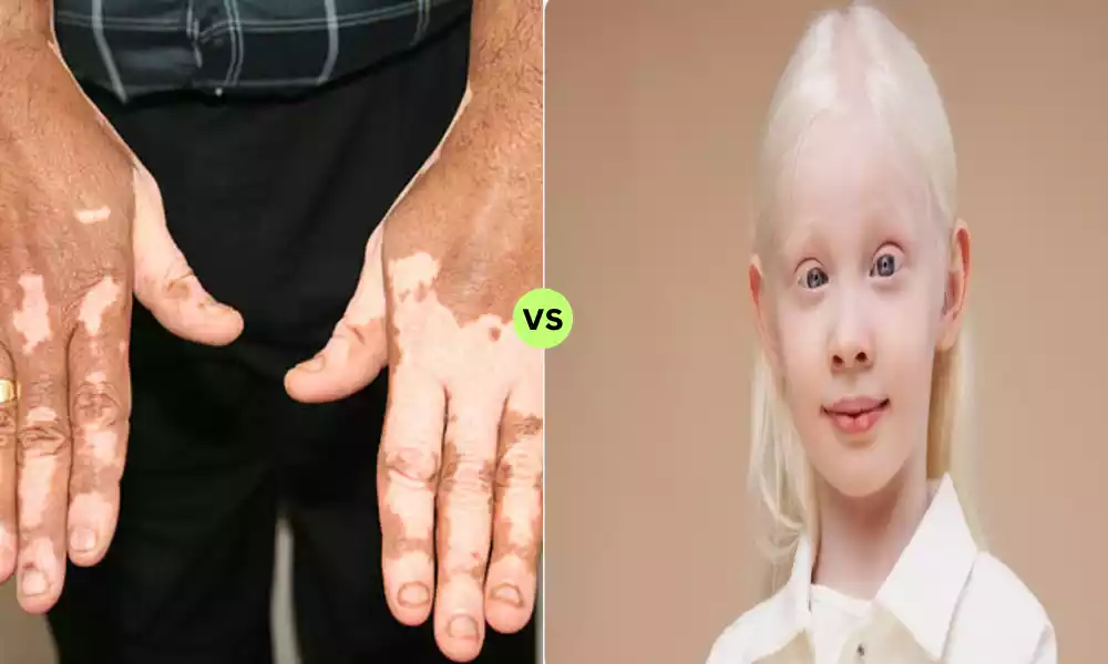 Leucoderma and Albinism