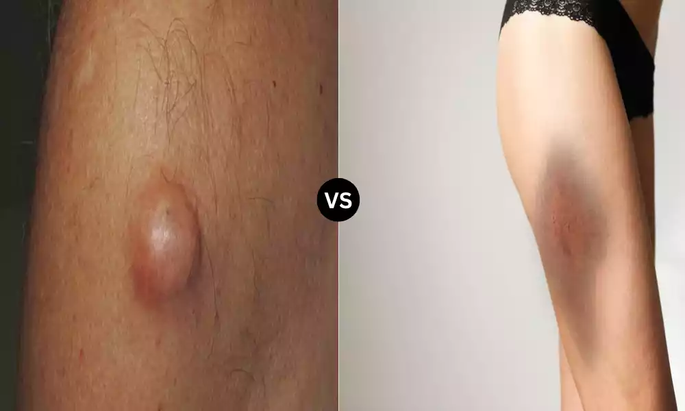 Best 9 Difference Between Lipoma and Hematoma