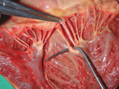Papillary Muscles