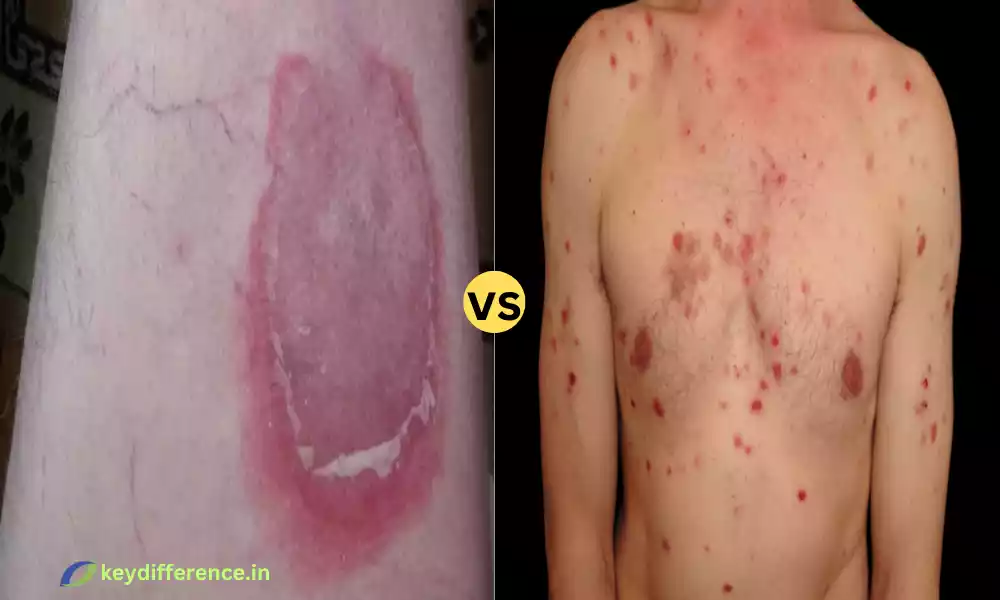 Difference Between Pemphigoid and Pemphigus