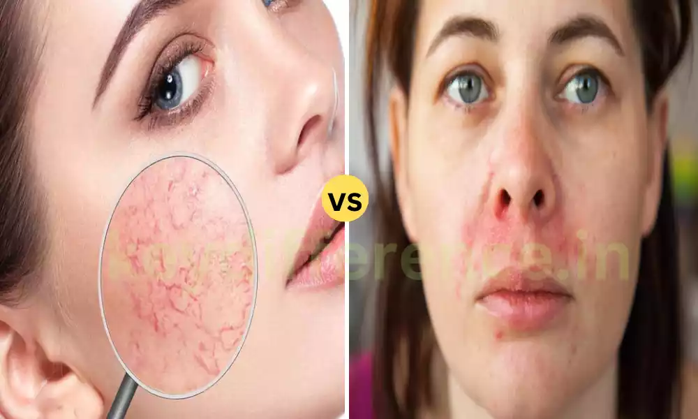 What is the 7 Difference Between Perioral Dermatitis and Rosacea