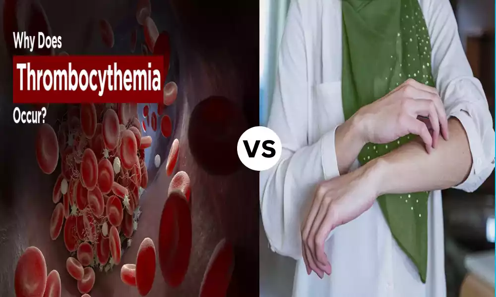 Top 9 Difference Between Polycythemia Vera and Essential Thrombocythemia