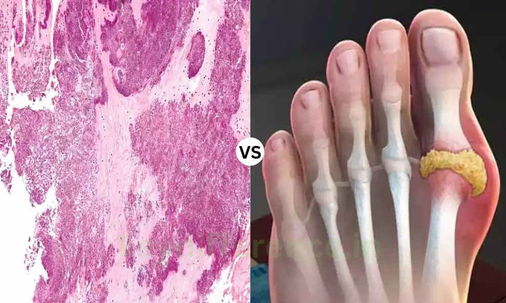 Top 12 Difference Between Pseudogout and Gout