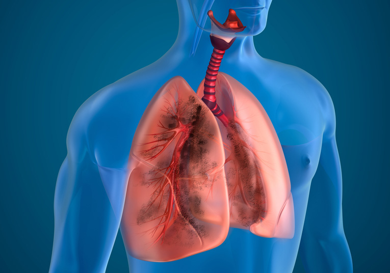 Restrictive Pulmonary Disease