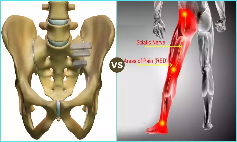 Best 9 Difference Between Sacroiliitis and Sciatica