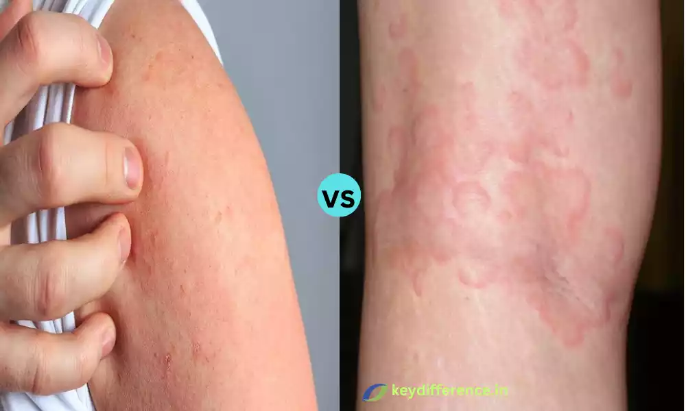 Scabies and Urticaria
