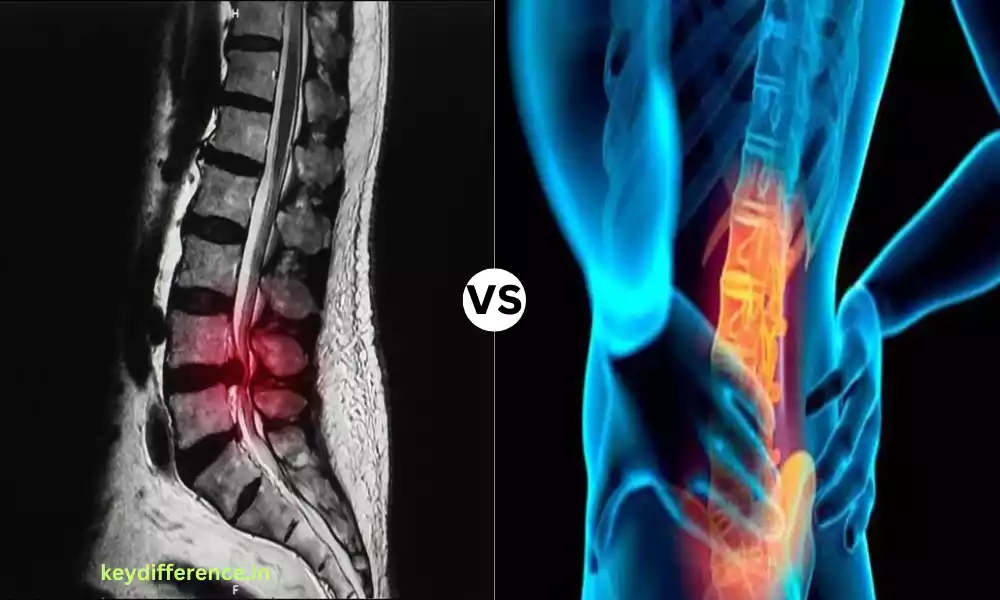 Top 10 Difference Between Spinal Stenosis and Spondylosis
