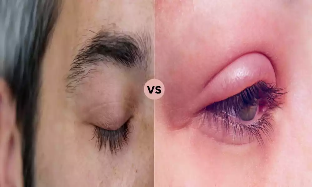 Squamous and Ulcerative Blepharitis
