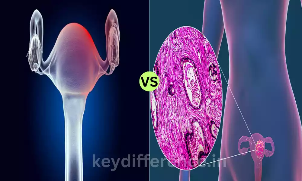 Adenomyosis and Uterine Cancer