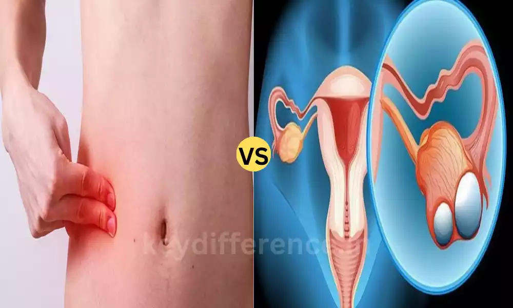Difference Between Appendicitis and Ovarian Cyst