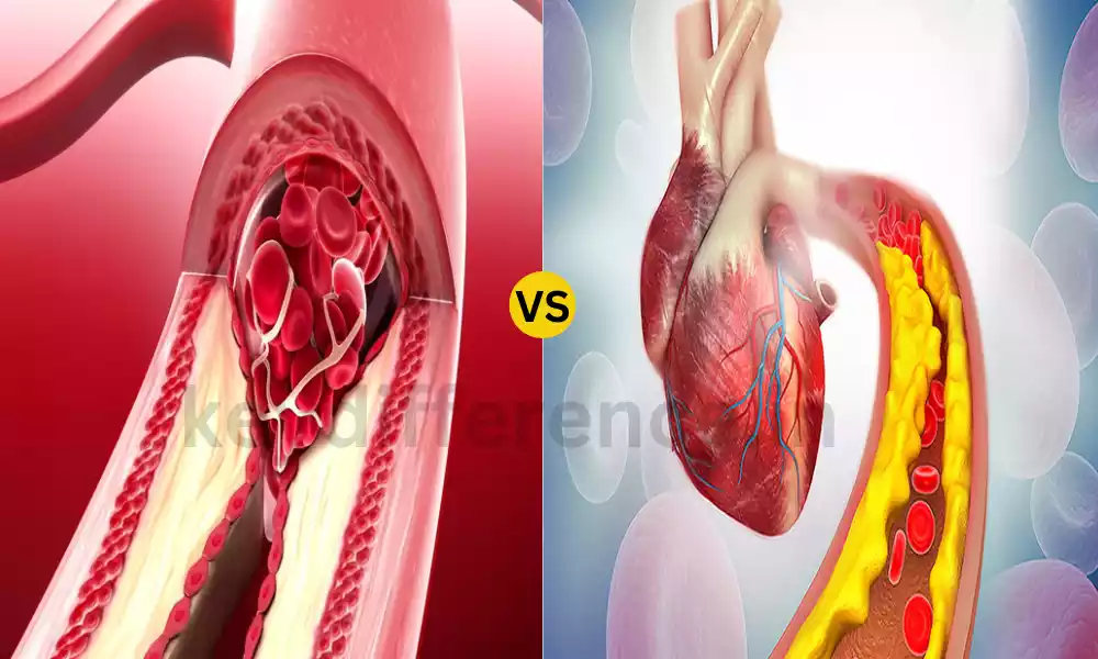 Difference Between Arteriosclerosis and Atherosclerosis