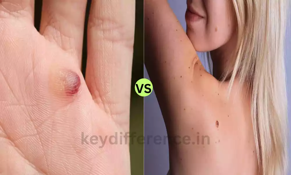 Difference Between Blood Blister and Melanoma