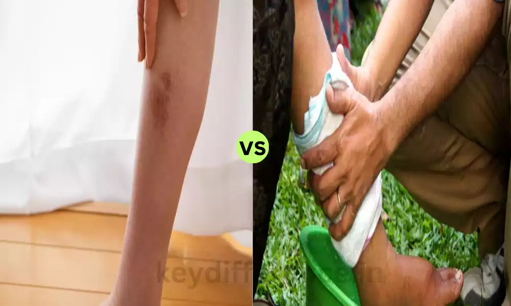 Difference Between Cellulitis and Filariasis