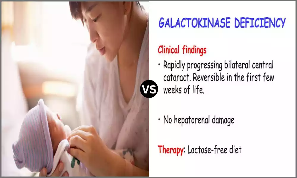 Galactosemia and Galactokinase Deficiency