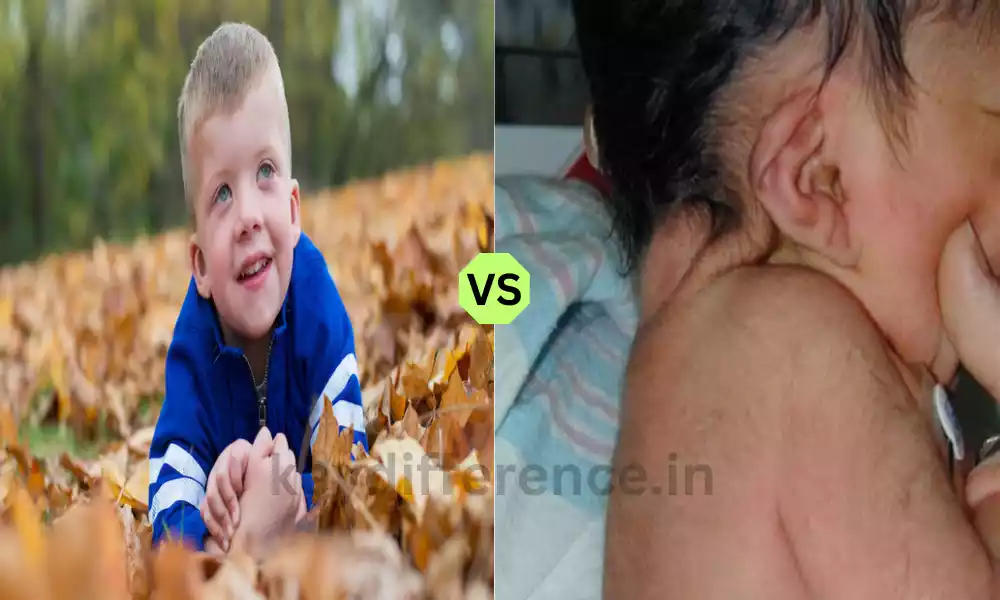 Difference Between Noonan Syndrome and Turner Syndrome