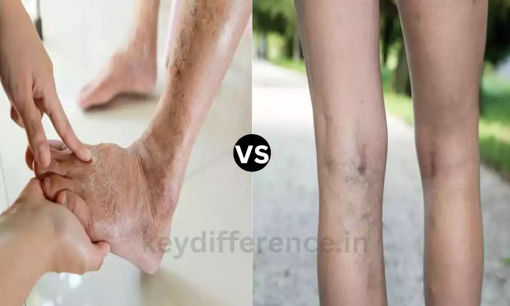 Difference Between PAD and Venous Insufficiency
