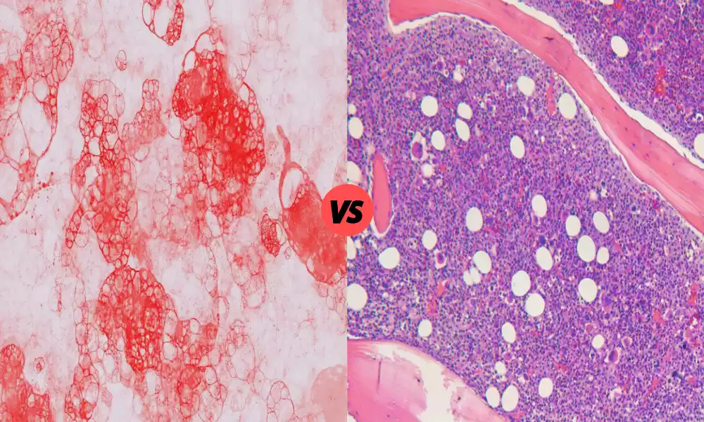 Difference Between Peripheral Blood and Bone Marrow Smear