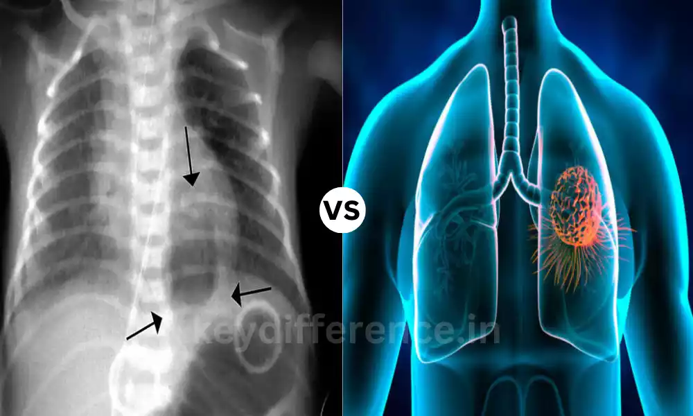 Difference Between Pneumatocele and Lung Abscess