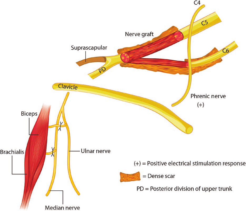 Preganglionic Brachial Plexus Injury