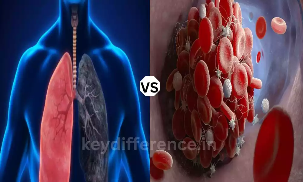 Pulmonary Embolism and Venous Thromboembolism